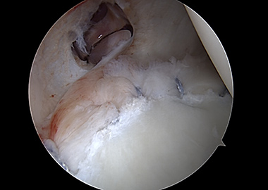 Posterior Shoulder Labral Repair