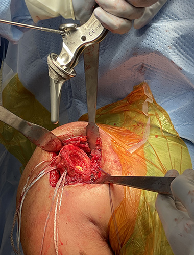 Reverse Shoulder Replacement