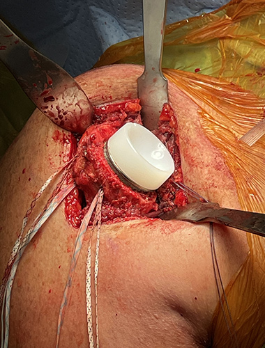 Reverse Shoulder Replacement