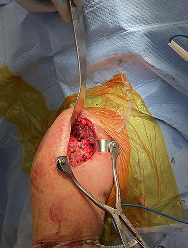Reverse Shoulder Replacement