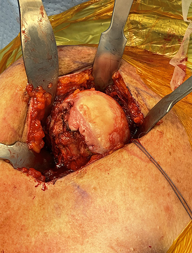 Reverse Shoulder Replacement