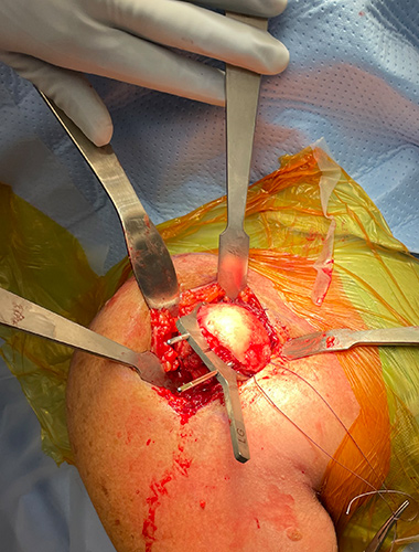 Reverse Shoulder Replacement
