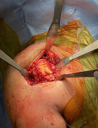 Reverse Shoulder Replacement