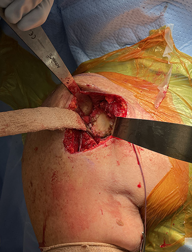 Reverse Shoulder Replacement