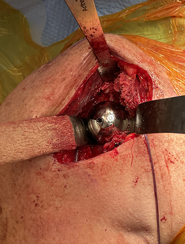 Reverse Shoulder Replacement