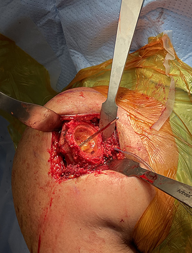 Reverse Shoulder Replacement