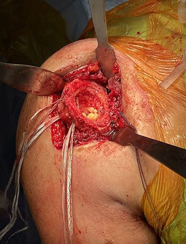 Reverse Shoulder Replacement