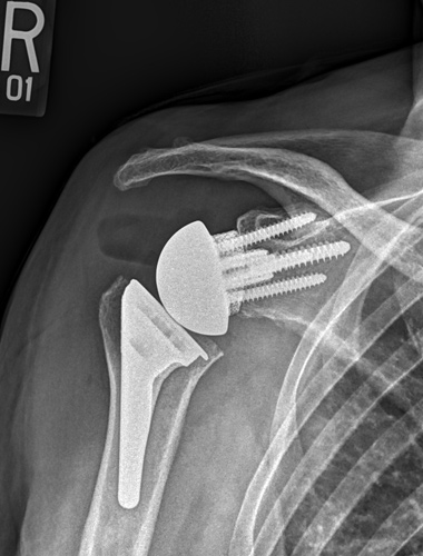 Reverse Shoulder Replacement