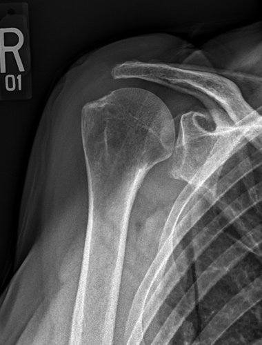 Reverse Shoulder Replacement