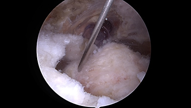 Rotator Cuff Repair