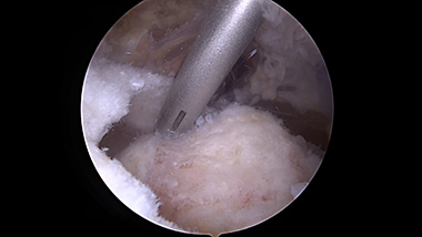Rotator Cuff Repair