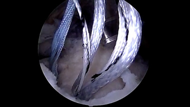 Rotator Cuff Repair