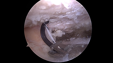 Rotator Cuff Repair