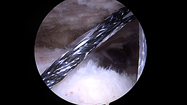 Rotator Cuff Repair