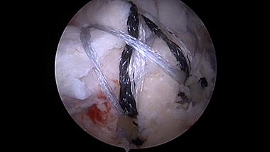 Rotator Cuff Repair