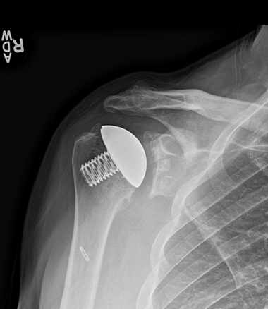Anatomic Shoulder Replacement