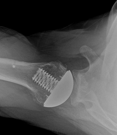 Anatomic Shoulder Replacement
