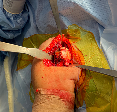 Anatomic Shoulder Replacement