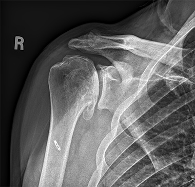 Anatomic Shoulder Replacement
