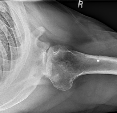 Anatomic Shoulder Replacement