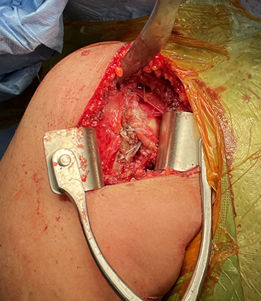 Anatomic Shoulder Replacement