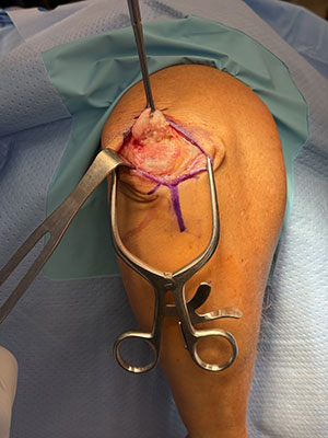 Triceps tendon repair  img