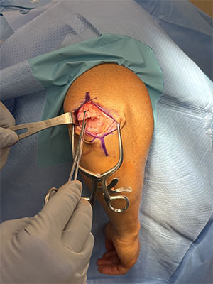 Triceps tendon repair  img
