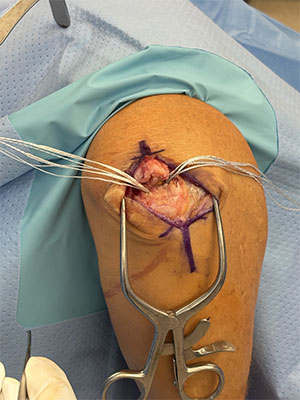 Triceps tendon repair  img