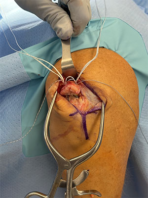 Triceps tendon repair img