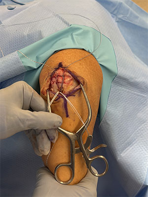 Triceps tendon repair  img