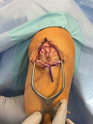 Triceps tendon repair  img