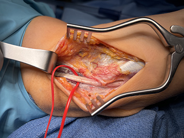 Ulnar Nerve Transposition