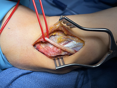 Ulnar Nerve Transposition